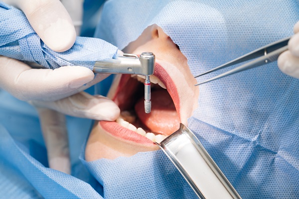 Dental Implant Surgery Boca Raton, FL