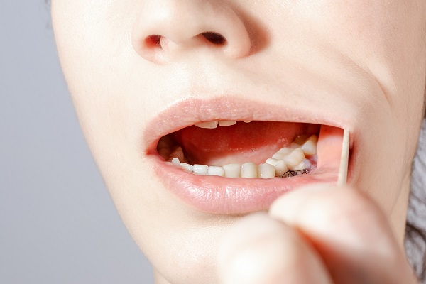 How Do I Know If I Need Gum Grafting?