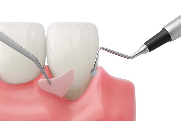 When To Consider Gum Grafting